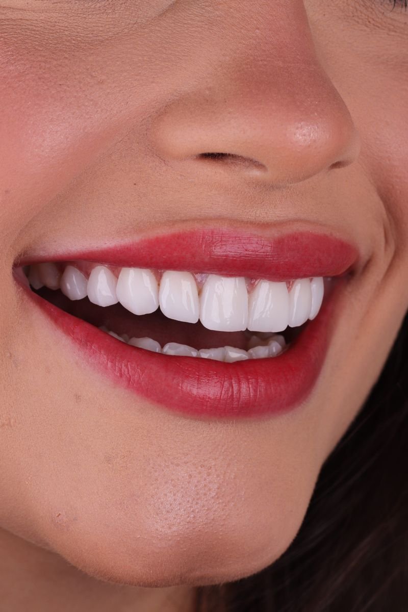 Facetas de Porcelana